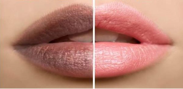 Imagem com lábios antes e depois de clareá-los