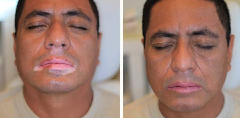 Homem com vitiligo após micropigmentação