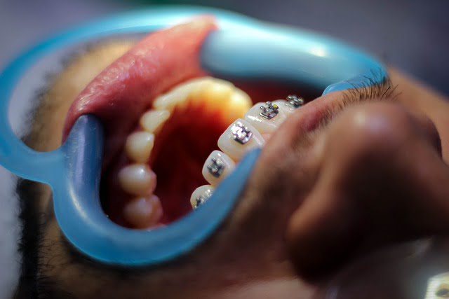 aparelho ortodontico mais rápido