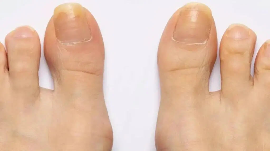 Amarelado das unhas