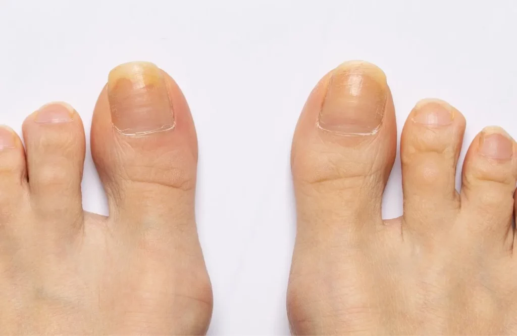 pés com unhas amarelas